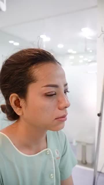 KHÁCH NÂNG MŨI CẤU TRÚC + CẮT MÍ MẮT VỪA THỰC HIỆN XONG