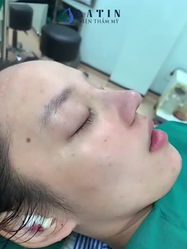 mũi cấu trúc bọc megaderm vừa hoàn thành xong.
