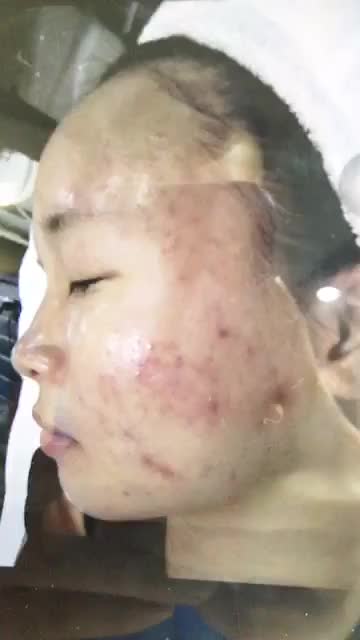 MỤN Ư? CHUYỆN NHỎ... ĐÃ CÓ KANGNAM LO..