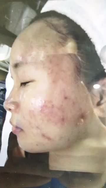 MỤN Ư? CHUYỆN NHỎ... ĐÃ CÓ KANGNAM LO..