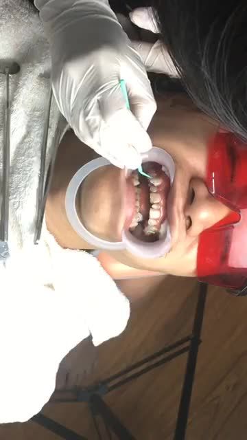 Niềng răng điều trị răng khấp khểnh có răng kẹ thừa tại Nha Khoa Vân Anh - Từ Sơn - Bắc Ninh