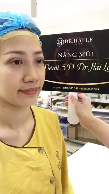 Cùng xem kết quả nâng mũi Demi 5D kết hợp thu cánh cho vị khách hàng một chiếc mũi cao tây và tự nhiên