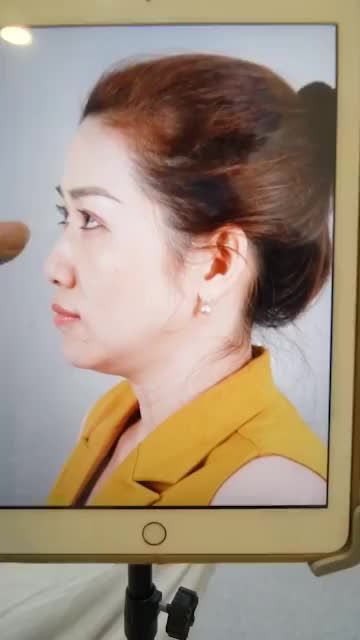 HOT LIVESTREAM: NÂNG MŨI CẤU TRÚC KẾT HỢP ĐỤC XƯƠNG MŨI MÀI GỒ VỪA THỰC HIỆN XONG