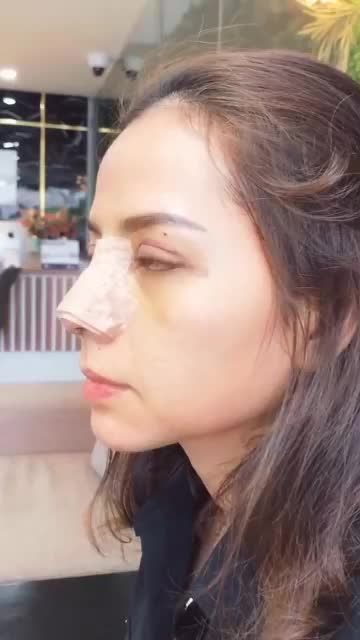 COMBO NÂNG MŨI - CẮT MÍ – TẠI DR HOẠT SAU 5 NGÀY TÁI KHÁM