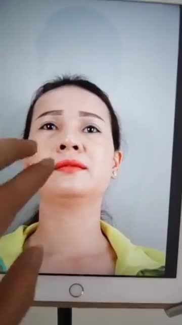 SỬA MŨI HỎNG SAU NÂNG – MŨI ĐẸP KHUÔN MẶT TRẺ TRUNG HƠN