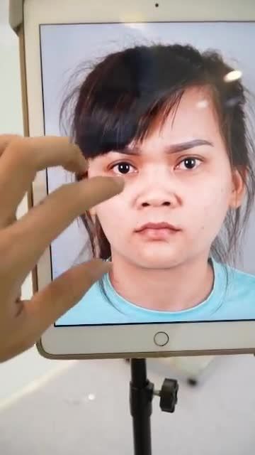 MŨI CẤU TRÚC VỪA THỰC HIỆN XONG TẠI DR HOẠT