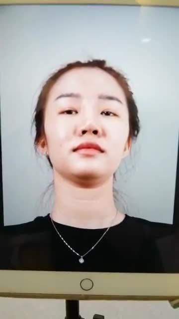 “EM SỬA MŨI 1 LẦN RỒI NHƯNG BỊ HỎNG, GIỜ EM MUỐN MŨI NHÌN TỰ NHIÊN HƠN”