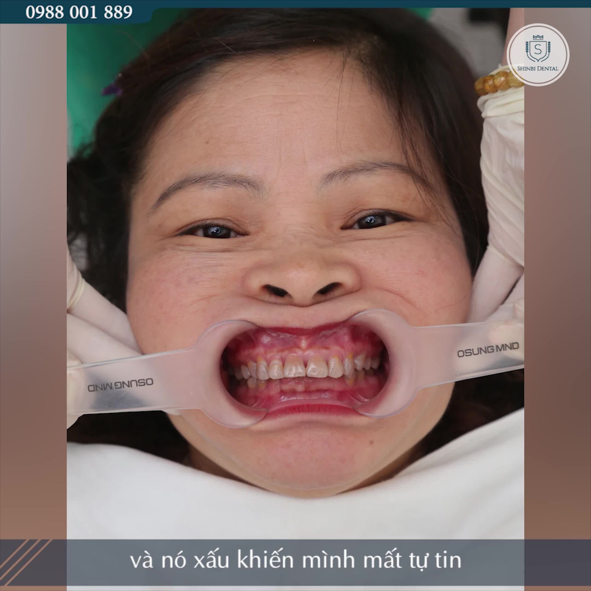 LÀM RĂNG SỨ TẠI SHINBI – BẢO TOÀN TỐI ĐA RĂNG GỐC