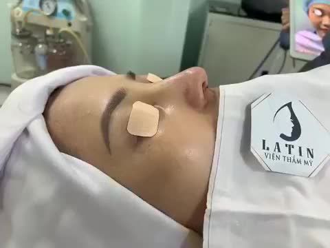 Mũi cấu trúc SỤN SƯỜN, surgiform của chị khách vừa hoàn thành xong.
