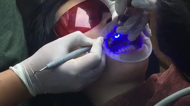 Quá trình dán 6 VENEER sứ điều trị RĂNG THƯA tại Nha Khoa Vân Anh - Từ Sơn - Bắc Ninh