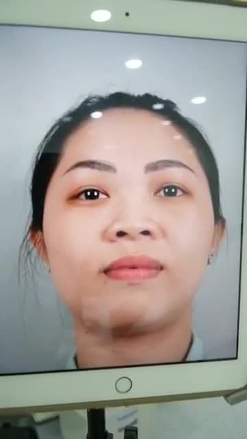 MŨI ĐẸP MẶT XINH CHỈ SAU 45P NÂNG MŨI CẤU TRÚC SỤN SURGIFORM