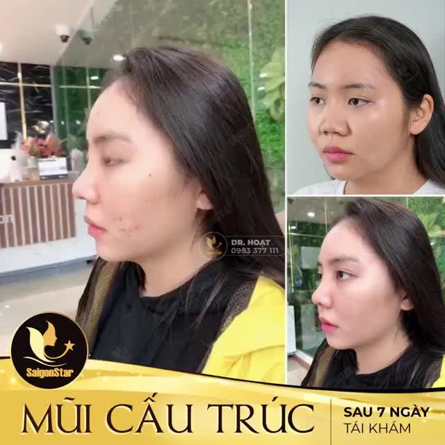 MŨI CẤU TRÚC SAU 7 NGÀY TÁI KHÁM