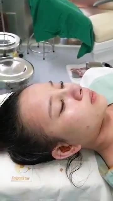 MŨI CẤU TRÚC VỪA THỰC HIỆN XONG – DÁNG MŨI CAO THON THU HÚT ÁNH NHÌN.