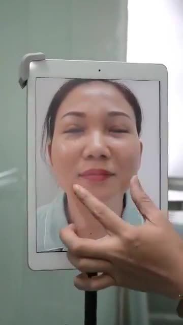 MŨI VỪA NÂNG XONG ĐẸP NGẤT NGÂY - KHÔNG SƯNG TÍM HAY PHÙ NỀ