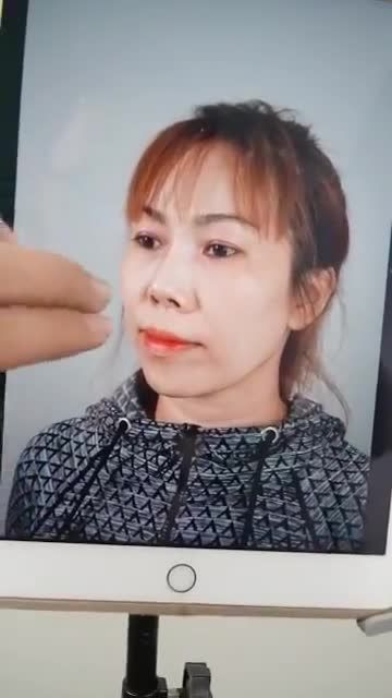 KHÁCH NÂNG MŨI CẤU TRÚC SỬA LẠI ĐẾN TÁI KHÁM