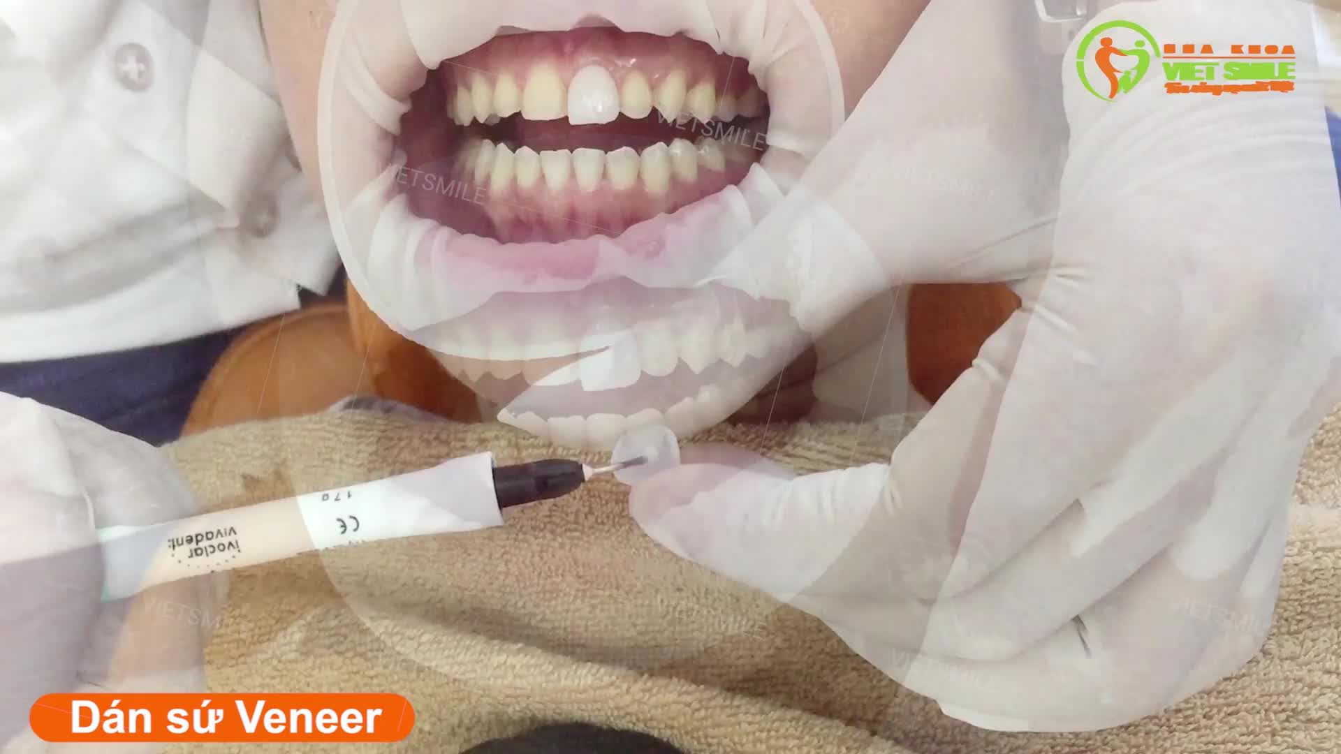 BẠN ĐANG LO LẮNG LÀM RĂNG THẨM MỸ PHẢI MÀI BÉ RĂNG