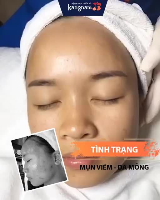 Mụn viêm, da mỏng - sau 3 buổi - da sạch, căng bóng