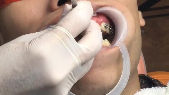 Niềng răng hô, thưa tại Nha Khoa Vân Anh - Từ Sơn - Bắc Ninh