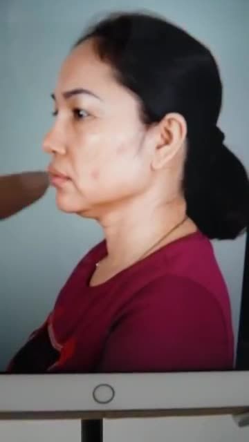 SỬA MŨI HỎNG CHO KHÁCH TỪNG NÂNG MŨI Ở ĐỊA CHỈ KHÁC