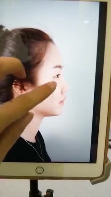 “EM SỬA MŨI 1 LẦN RỒI NHƯNG BỊ HỎNG, GIỜ EM MUỐN MŨI NHÌN TỰ NHIÊN HƠN”