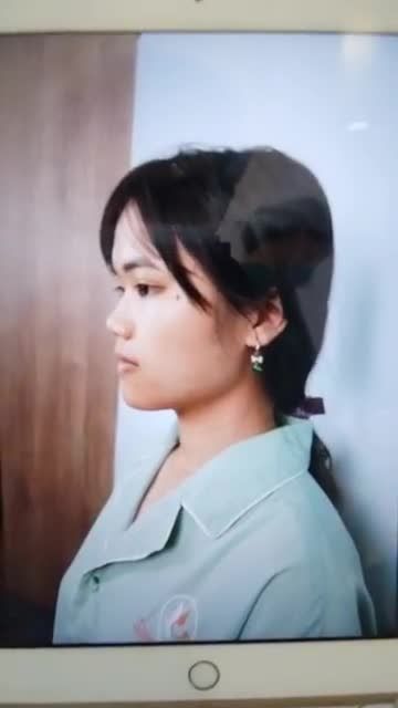 KHÔNG CÒN MŨI TẸT, THẤP, HẾCH - XEM NGAY KẾT QUẢ VỪA THỰC HIỆN XONG