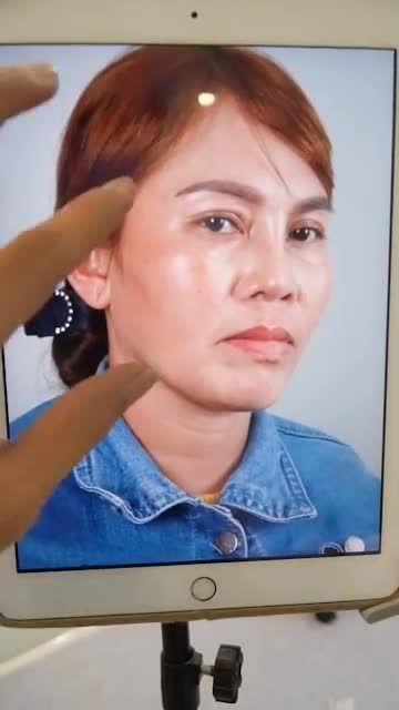 THÊM 1 CASE NÂNG MŨI CẤU TRÚC VỪA THỰC HIỆN XONG TẠI DR HOẠT