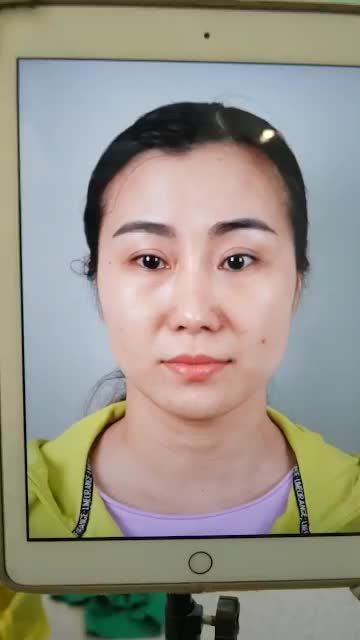 MŨI ĐẸP NGAY VỚI KẾT QUẢ NÂNG MŨI CẤU TRÚC SỤN SƯỜN SỬA LẠI VỪA THỰC HIỆN XONG