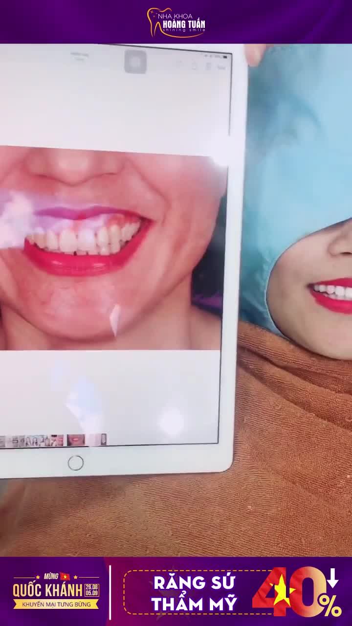 Biến hình nụ cười hở lợi, răng vàng ố với răng sứ HT Smile