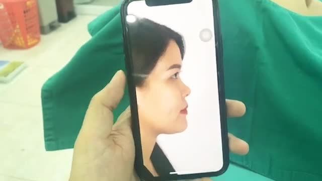 CẢI THIỆN DÁNG MŨI BẰNG PHƯƠNG PHÁP NÂNG MŨI S-FORM KẾT HỢP BỌC CÂN THÁI DƯƠNG