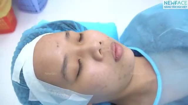 Cận cảnh nâng mũi dùng 3 vật liệu: sụn tai, vách ngăn nhân tạo và silicone