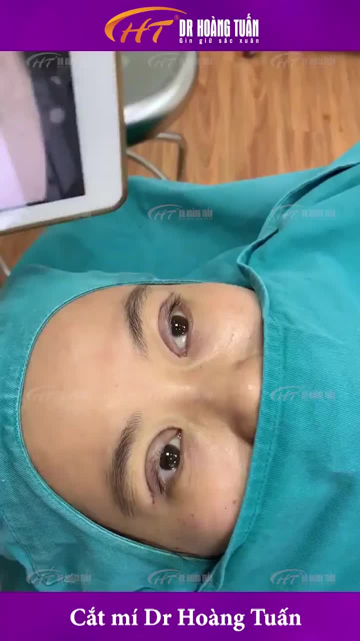 30 phút cắt mí - cho nếp mí to, rõ hơn!