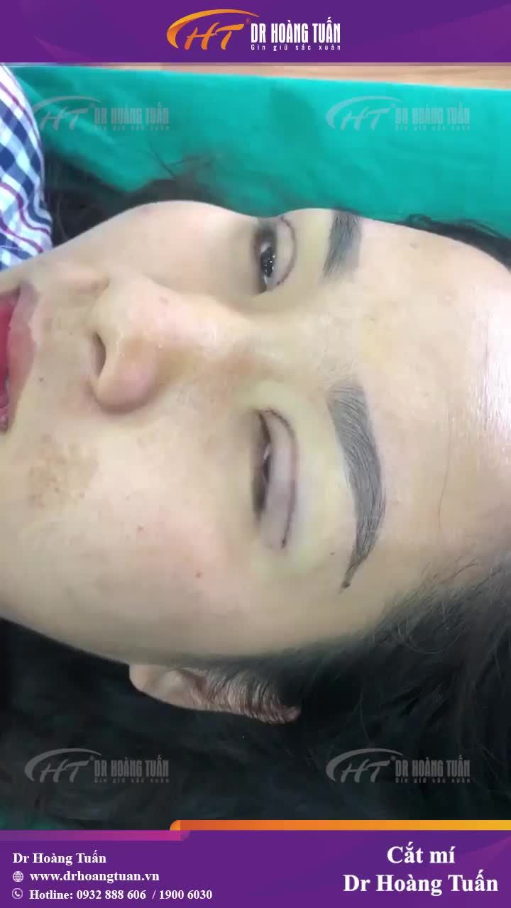Mắt nhiều da và mỡ thừa mà lại đi nhấn mí và cái kết sau 3 tháng!