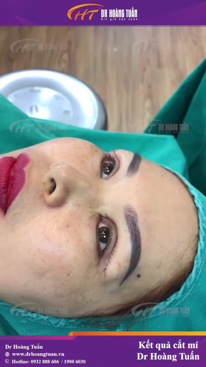 Loại bỏ da thừa, tạo nếp mí tròn đều hơn bằng phương pháp cắt mí Dr Hoàng Tuấn!