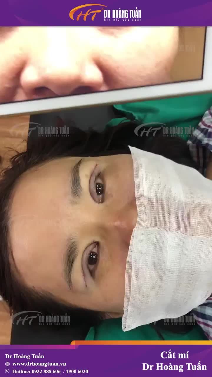 Mắt sâu do bọng mỡ quá to, mi mắt sụp xuống, nếp mí không rõ ràng?