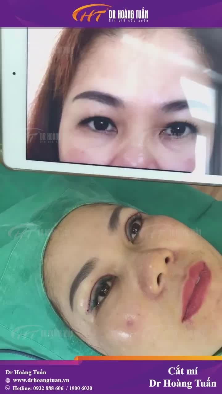 Không còn lo lắng về đôi mắt một mí nhiều da chùng, mỡ thừa nữa