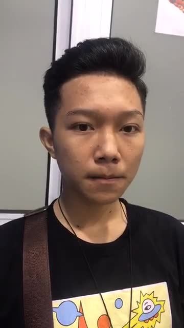 Nỗi ám ảnh SỤP MÍ BẨM SINH ? Làm sao khắc phục⁉️