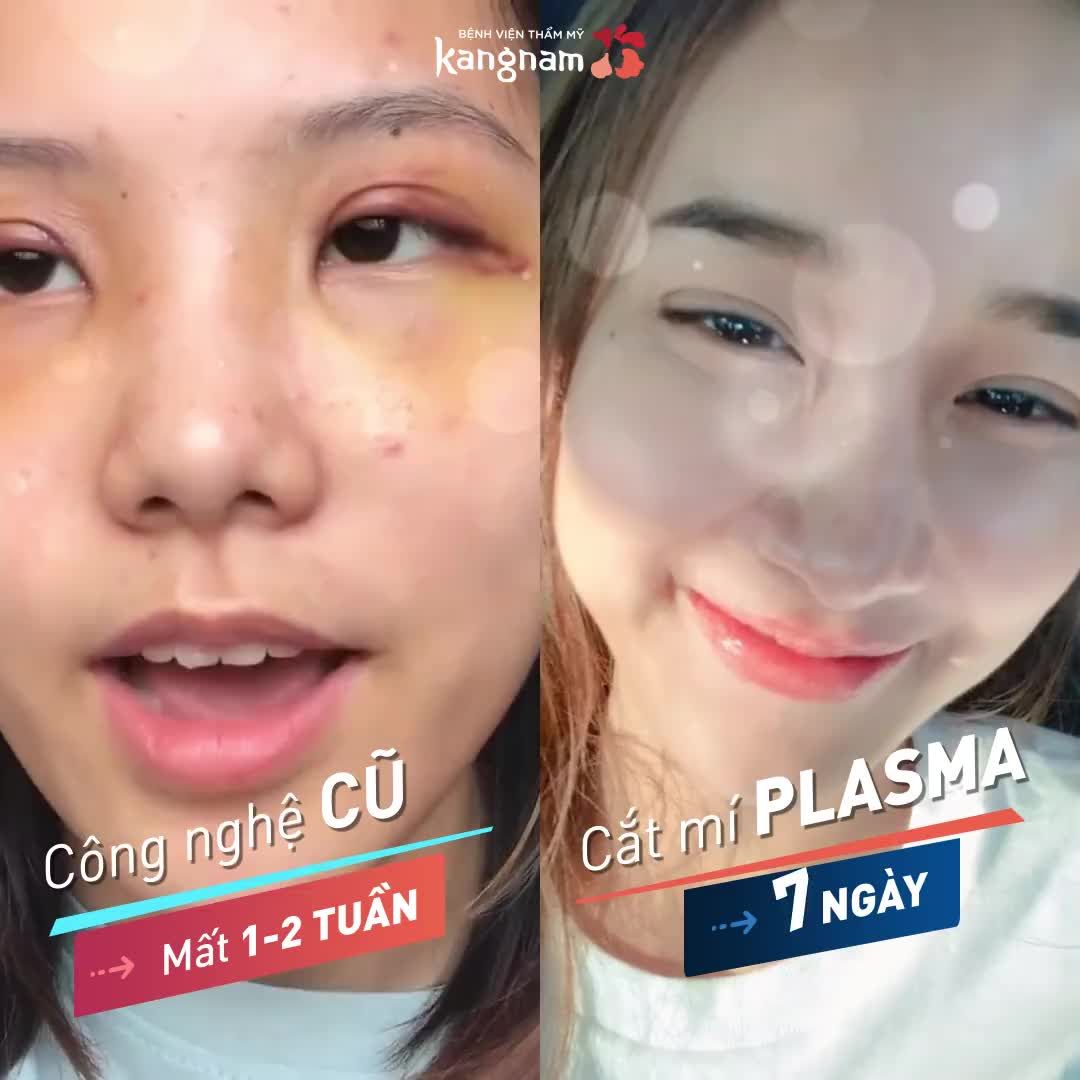 CẮT MÍ - Bao lâu thì ĐẸP TỰ NHIÊN?