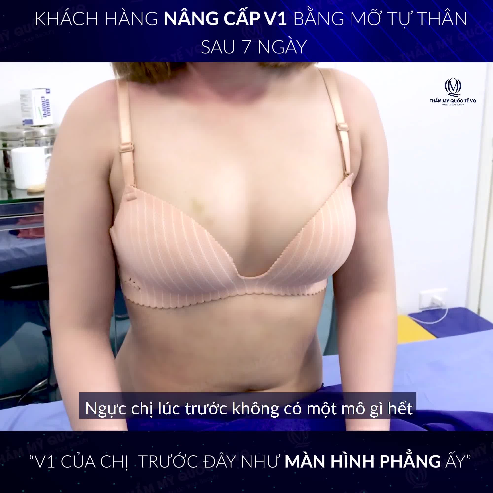 CHIA SẺ CỦA KHÁCH HÀNG NÂNG CẤP V1 BẰNG MỠ TỰ THÂN SAU 7 NGÀY