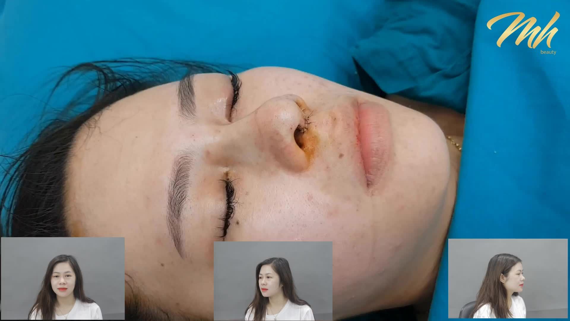 Cùng nhìn ngắm khách hàng của MH Beauty sau khi nâng mũi nha cả nhà!