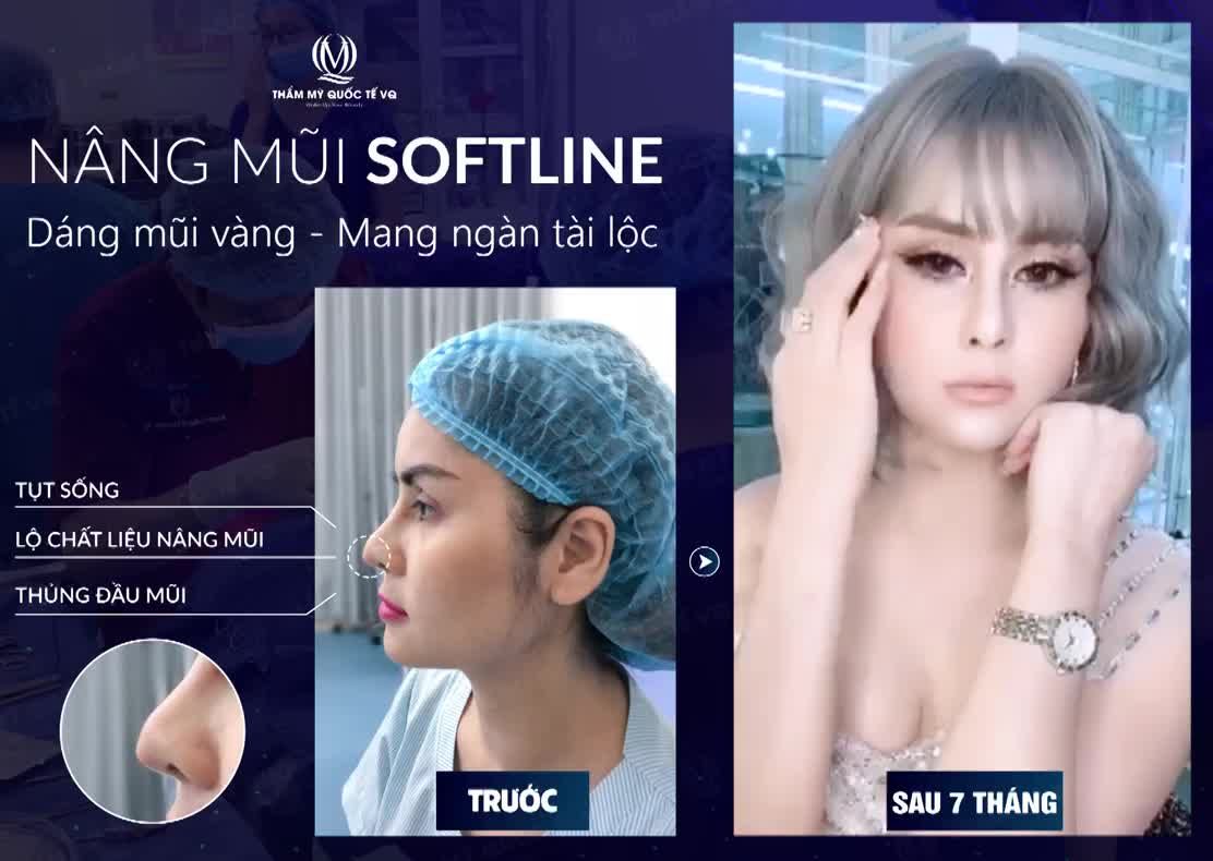 NÂNG MŨI SOFTLINE SAU 7 THÁNG