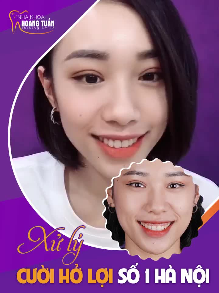 KHÁCH XINH ĐẸP CƯỜI HOÀN HẢO HƠN NGAY SAU TRẢI NGHIỆM DỊCH VỤ TẠI NHA KHOA HOÀNG TUẤN