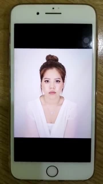 Nâng mũi Sline bọc sụn. Dáng mũi siêu xinh cho khách hàng 24 tuổi