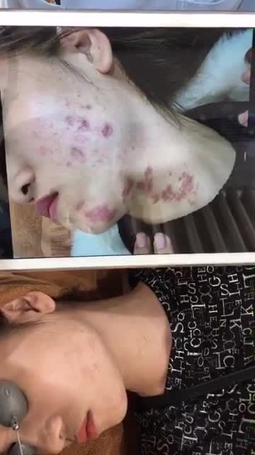 Đầu giờ chiều với case u máu thứ 11 trong ngày!