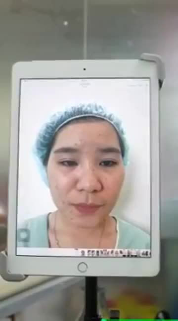 ĐỈNH CAO NÂNG MŨI CẤU TRÚC DR HOẠT LÀ ĐÂY – XEM KẾT QUẢ NGAY SAU PT