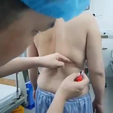 Đo vẽ trước khi bước vào ca phẫu thuật hút mỡ cho vị khách hàng