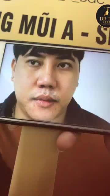 Mời các bạn đón xem kết quả sau phẫu thuật tạo hình mũi A Shape 5 ngày tại Dr_Trí!