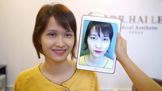 Đôi mắt u buồn hóa tươi trẻ chỉ sau 30 phút thực hiện cắt mí Mani Open Deep 5D