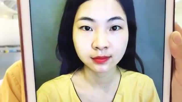 Khuôn mặt thân thiện và xinh như hotgirl chỉ sau 30 phút Cắt mí Mani Open Deep 5D