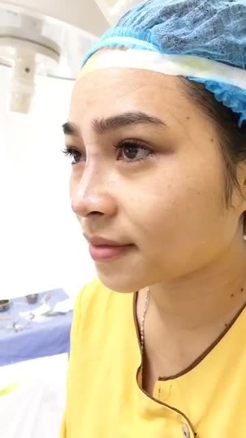 Mới nâng mũi xong chưa thể đẹp ngay, muốn đẹp phải có thời gian bình phục và ổn định chị em nhé! Theo dõi form mũi vừa thực hiện xong tại Dr.Hải Lê để có thêm động lực nâng mũi nhé cả nhà!