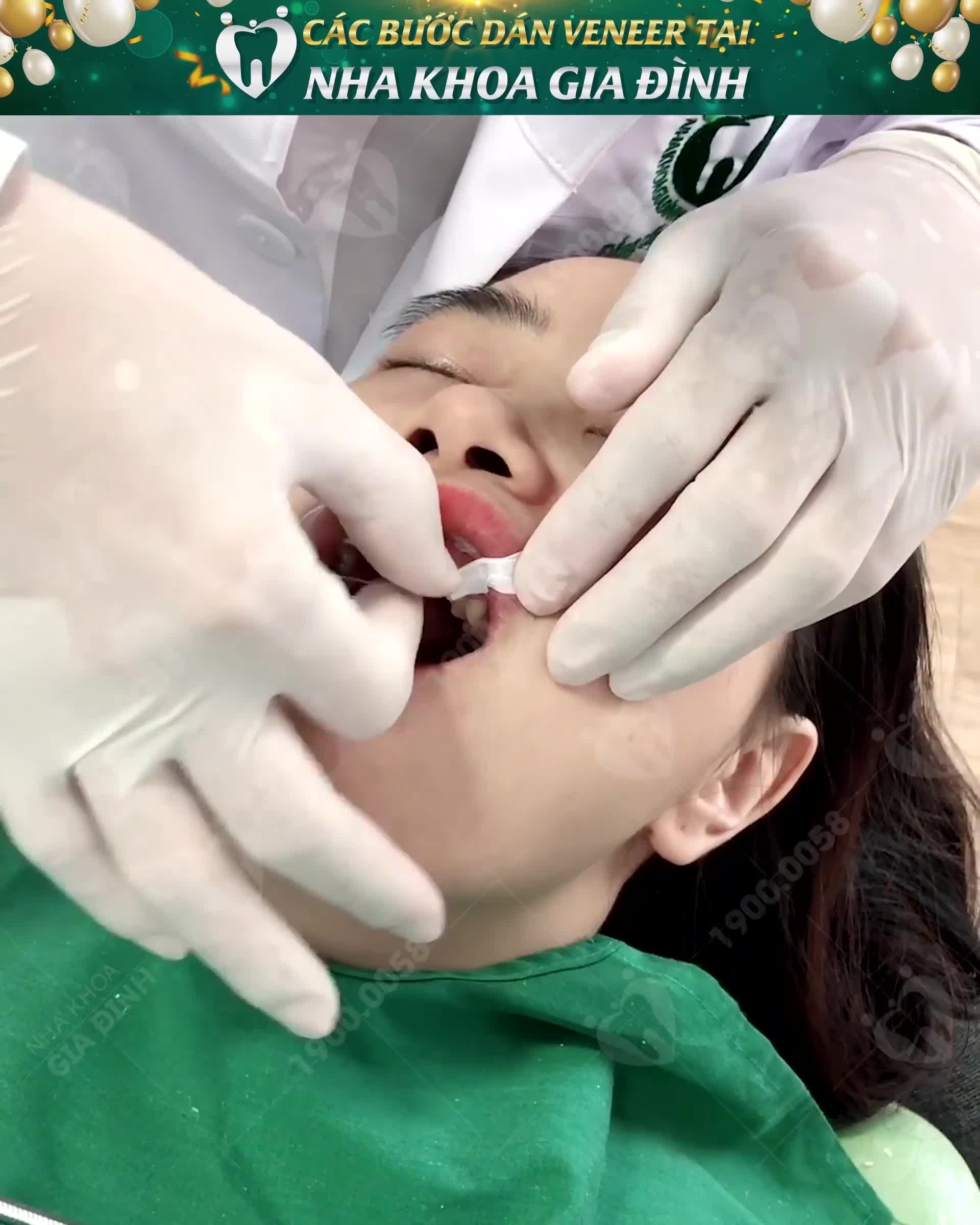 DÁN SỨ VENEER ULTRATHIN KHÔNG MÀI NHỎ LÀ CÓ THẬT